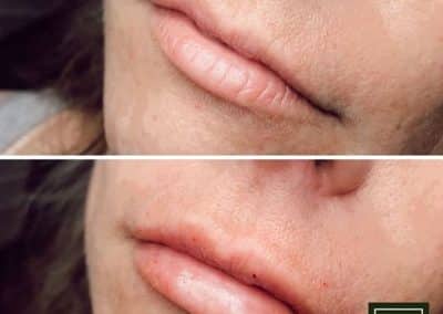 Lip Filler patient Before and After photos from FBTMed, Faith in Beauty in Medway MA