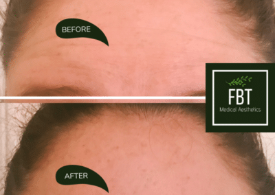 Patient Botox Injections Before and After photos from FBTMed, Faith in Beauty in Medway MA