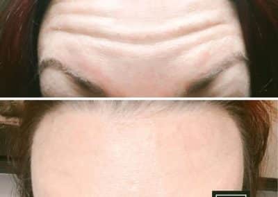 Patient Botox Injections Before and After photos from FBTMed, Faith in Beauty in Medway MA