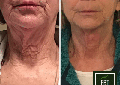 Evoke patient Before and After photos from FBTMed, Faith in Beauty in Medway MA