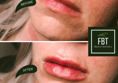 JUVEDERM patient Before and After photos from FBTMed, Faith in Beauty in Medway MA