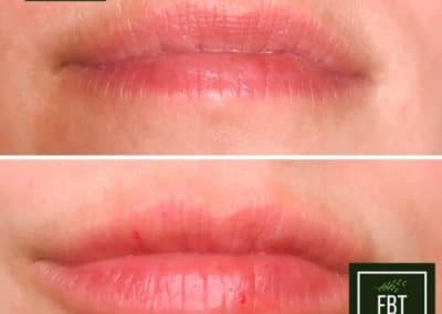 Lip Enhancement patient Before and After photos from FBTMed, Faith in Beauty in Medway MA